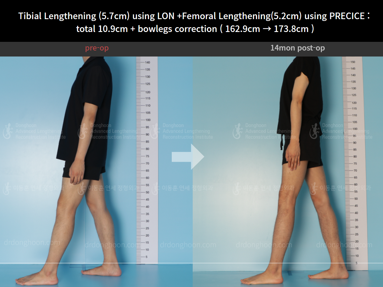 Before and after cll + deformity correction, case 8417894, image 8, Dr. Donghoon institute (DALRI)