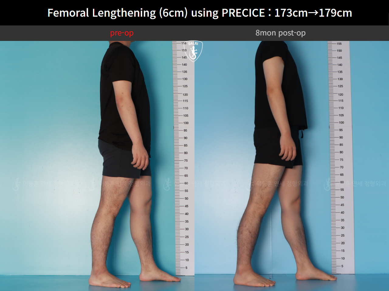 Before and after cll precice, case 89066969, image 4, Dr. Donghoon institute (DALRI)