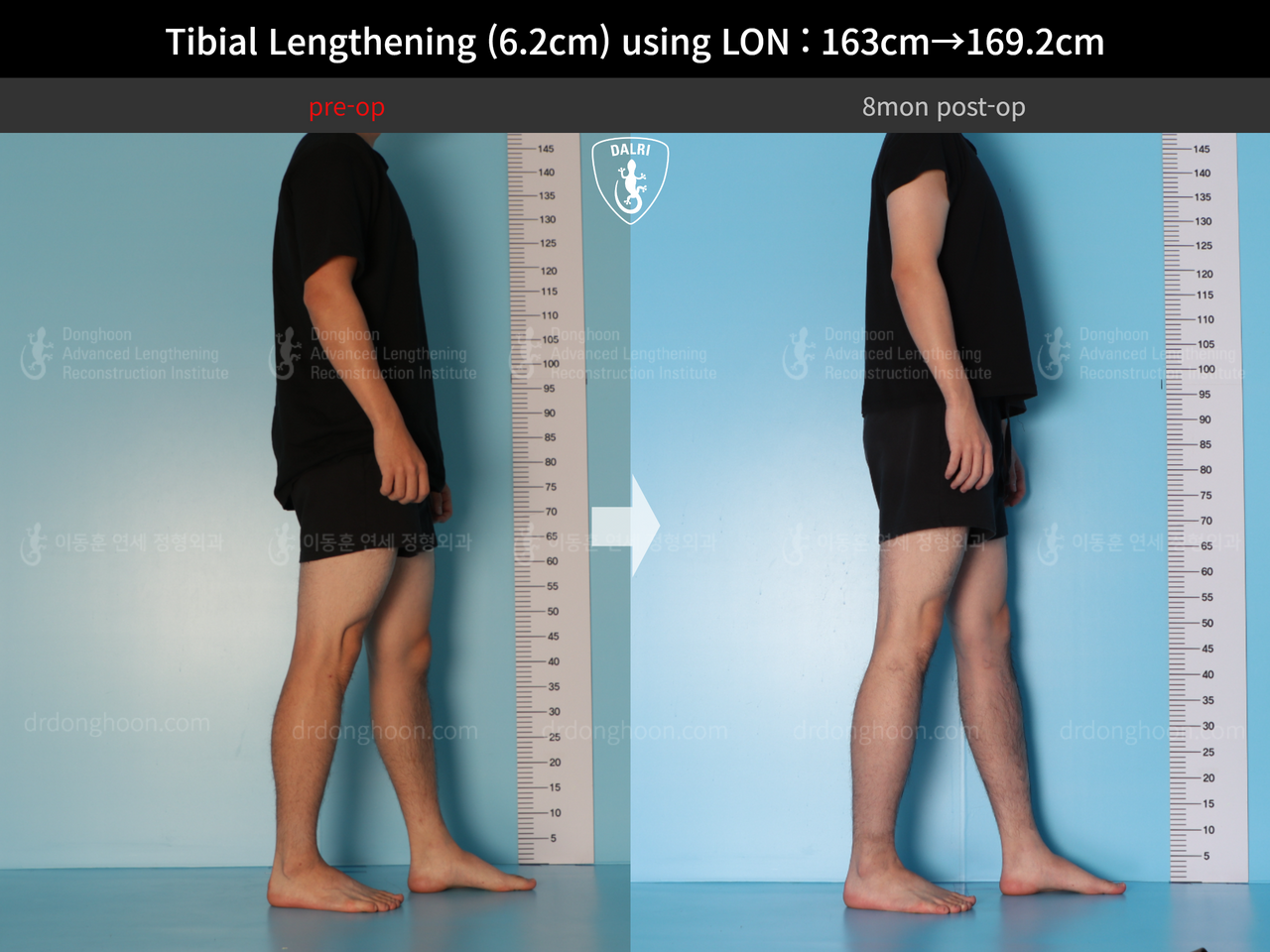 Before and after cll lon, case 14135787, image 4, Dr. Donghoon institute (DALRI)