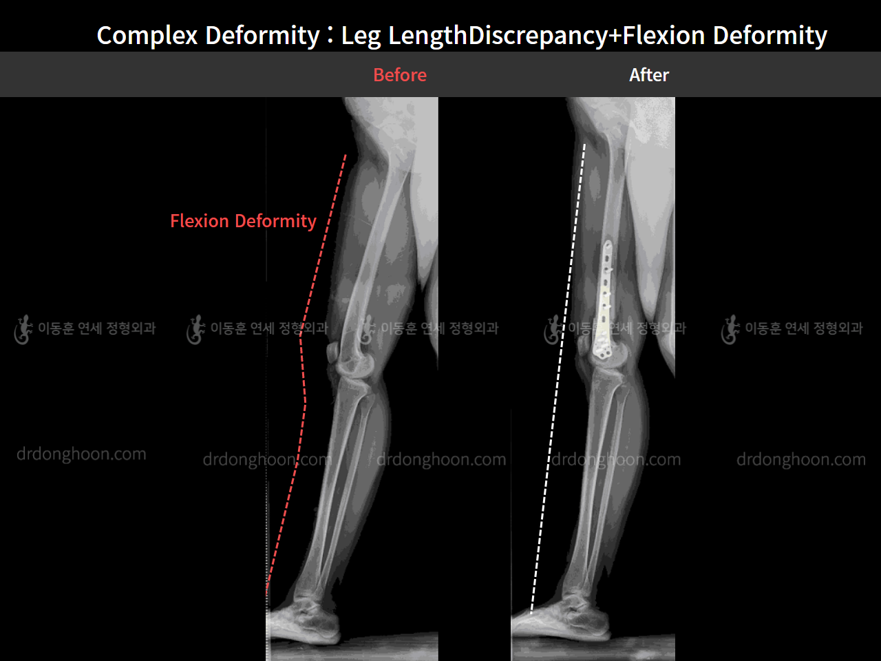 Before and after complex deformity, case 7397571, image 3, Dr. Donghoon institute (DALRI)