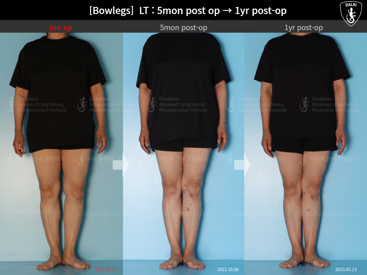 Before and after adult bowlegs, case 15172734, image 2, Dr. Donghoon institute (DALRI)