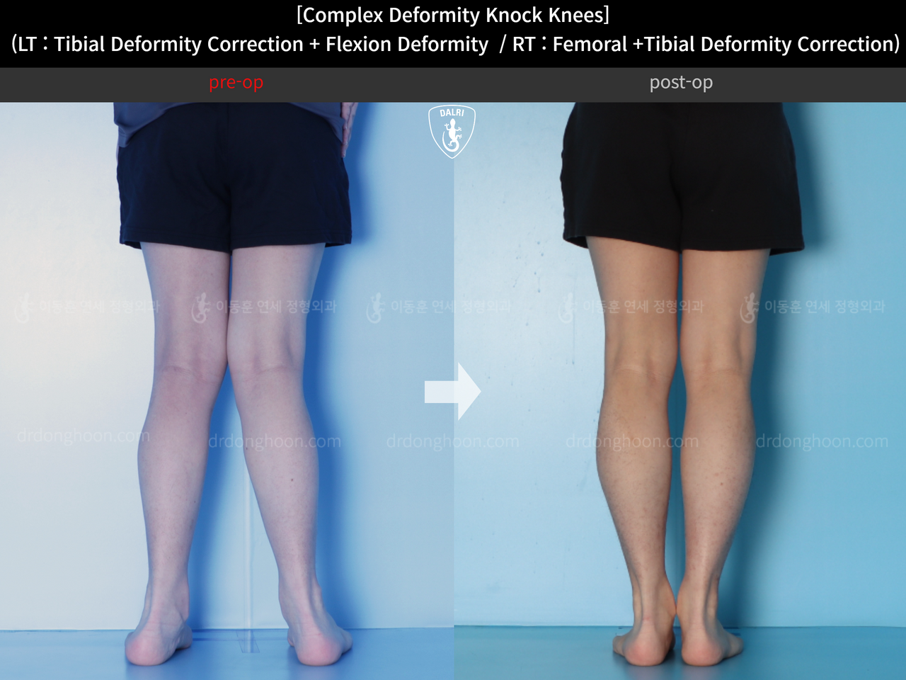 Before and after adult knock knees, case 14439339, image 7, Dr. Donghoon institute (DALRI)