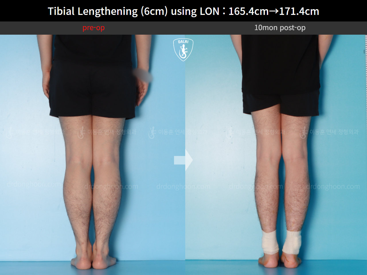 Before and after cll lon, case 15716525, image 10, Dr. Donghoon institute (DALRI)