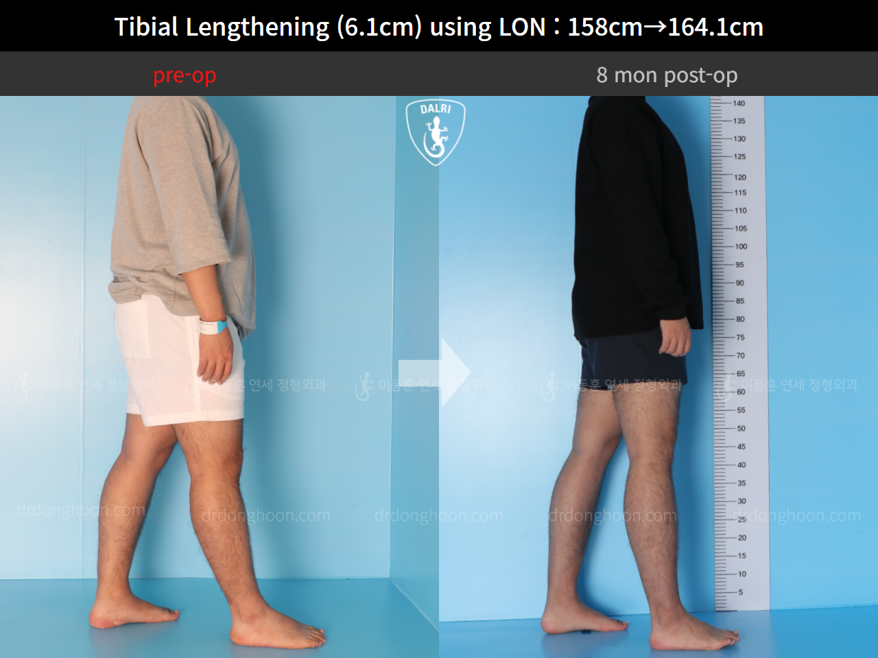 Before and after cll lon, case 4577743, image 3, Dr. Donghoon institute (DALRI)