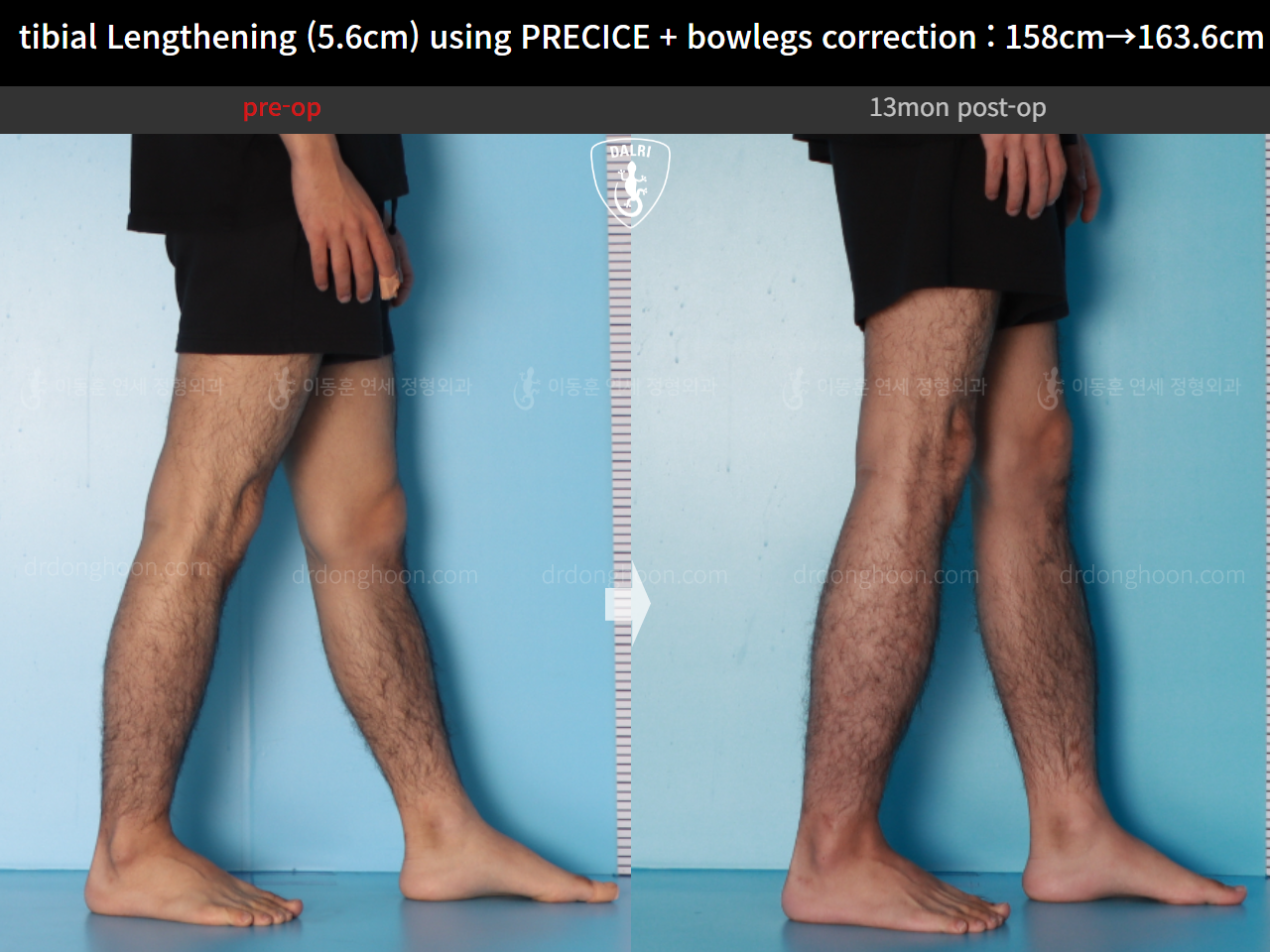 Before and after cll precice, case 16213622, image 10, Dr. Donghoon institute (DALRI)
