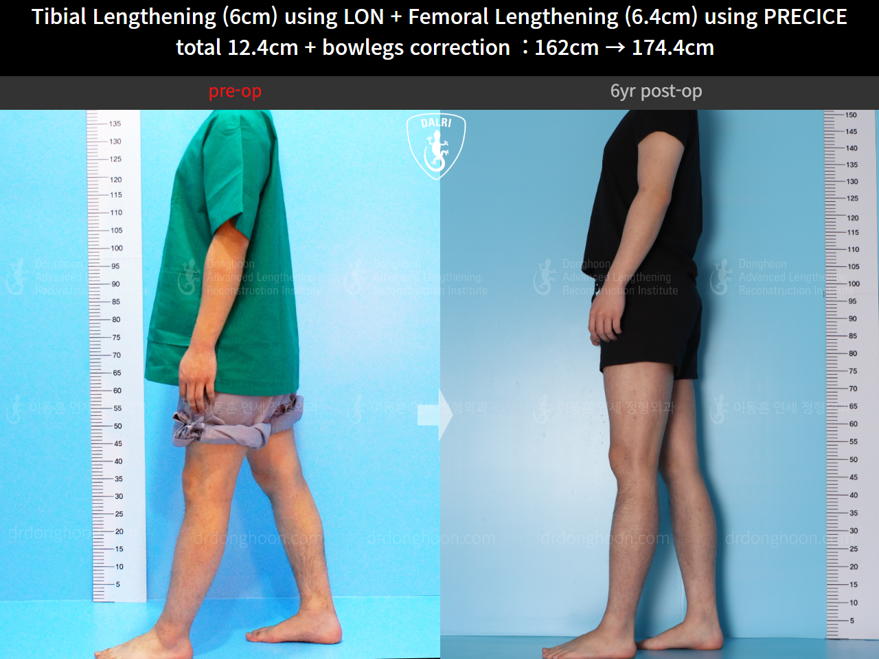Before and after cll precice, case 14631295, image 8, Dr. Donghoon institute (DALRI)