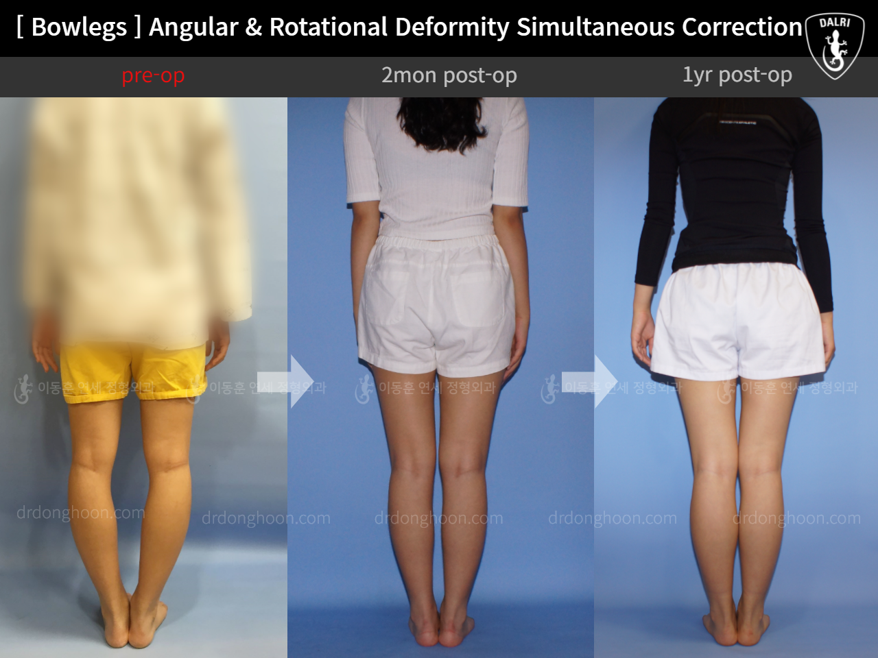 Before and after adult bowlegs, case 9036639, image 2, Dr. Donghoon institute (DALRI)