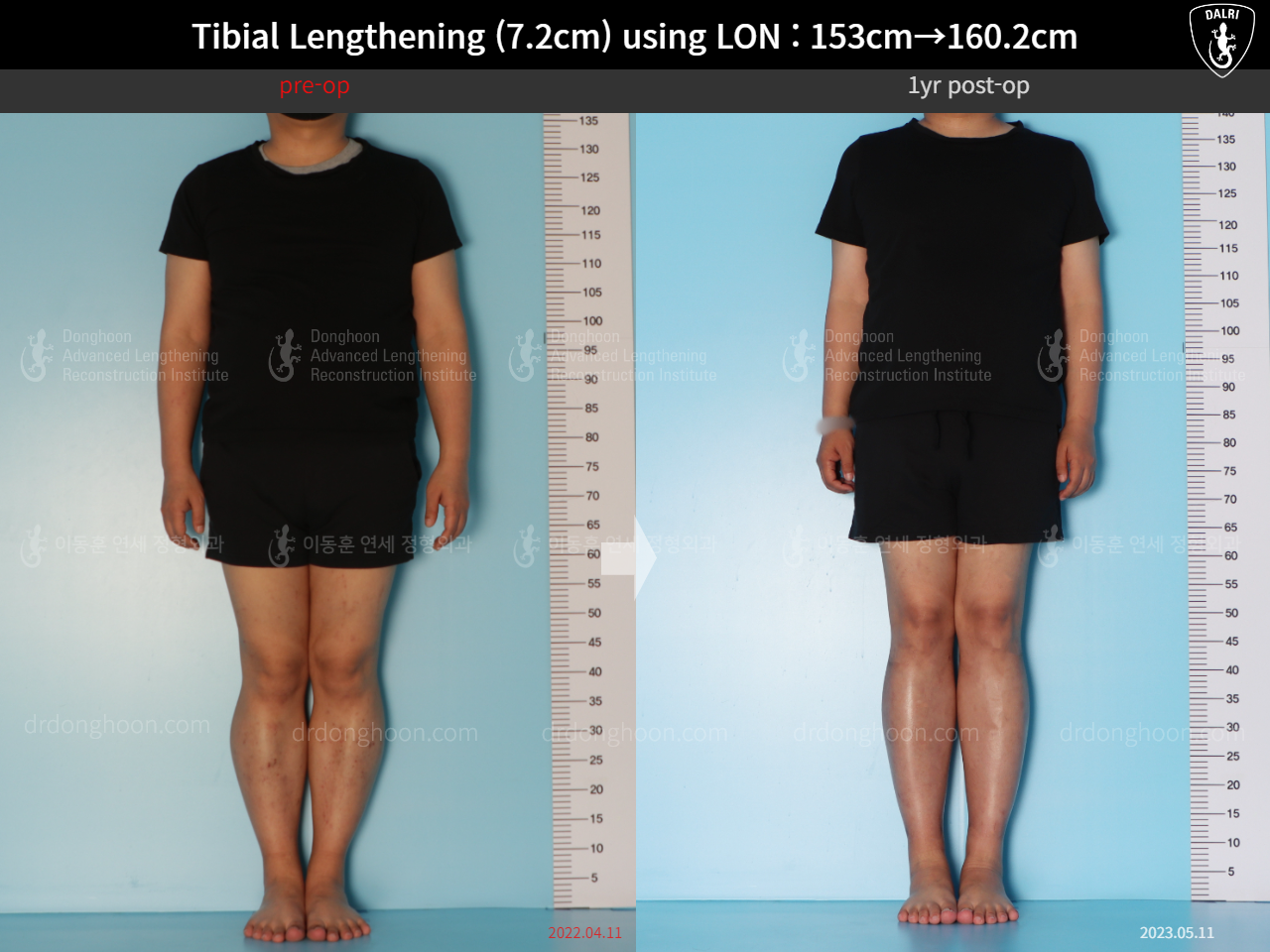 Before and after cll lon, case 15150707, image 1, Dr. Donghoon institute (DALRI)