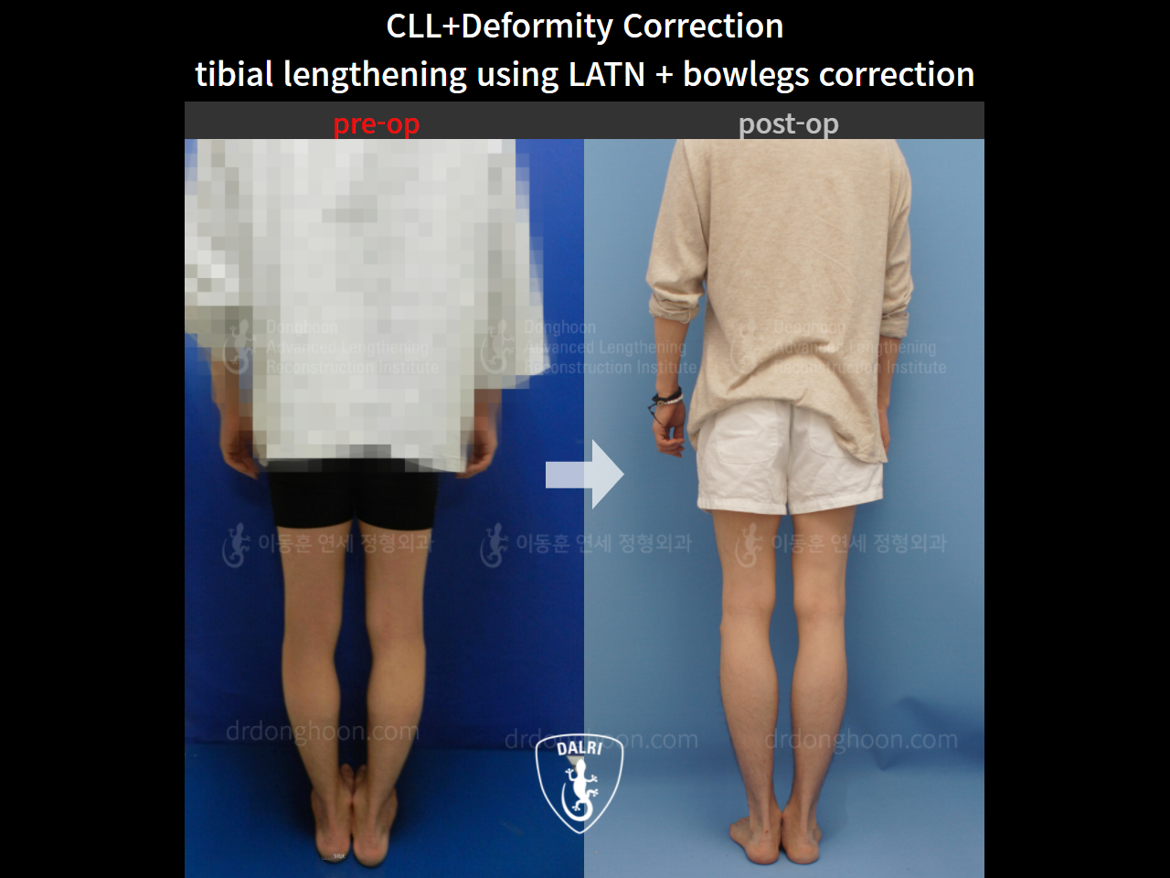 Before and after cll + deformity correction, case 4567585, image 3, Dr. Donghoon institute (DALRI)