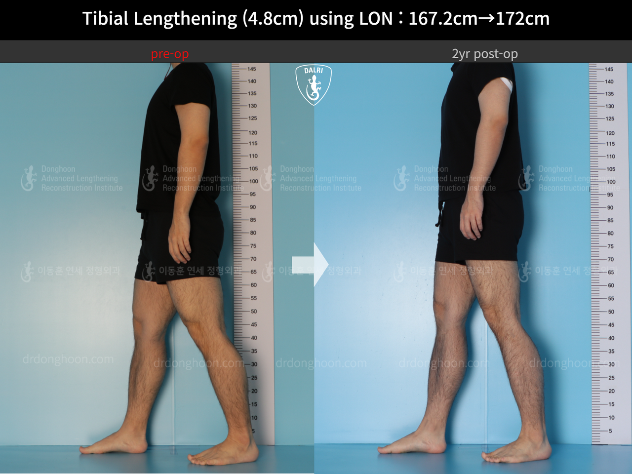 Before and after cll lon, case 14418932, image 4, Dr. Donghoon institute (DALRI)