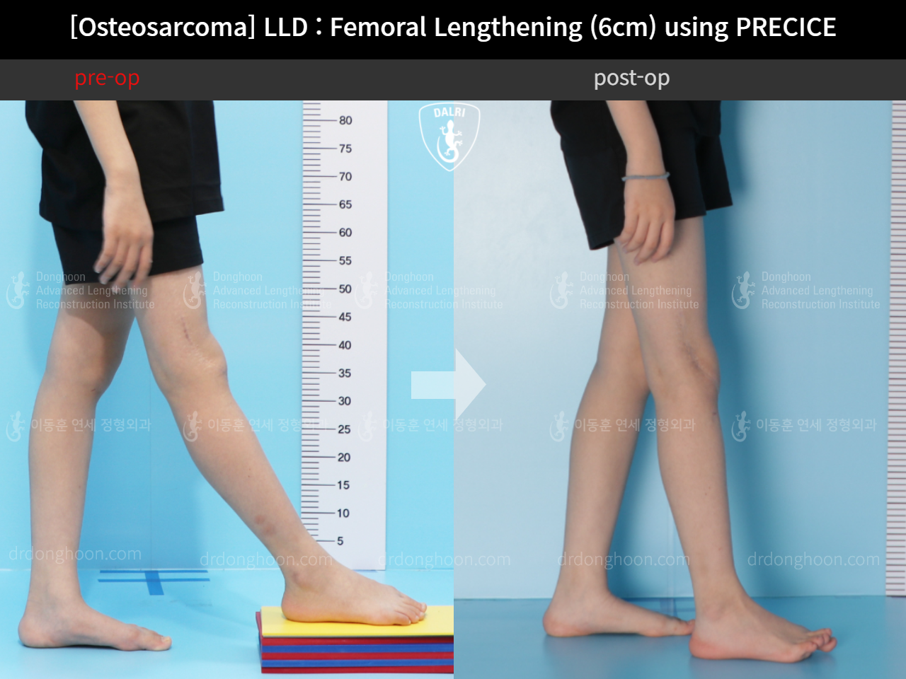Before and after post-trauma deformity, case 11378057, image 3, Dr. Donghoon institute (DALRI)