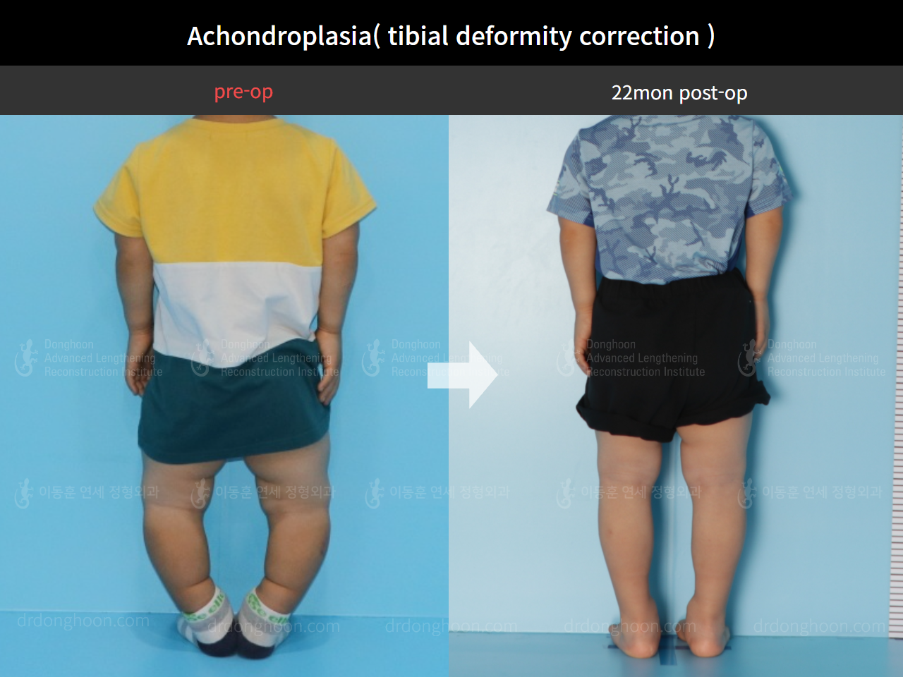 Before and after paediatric congenital condition, case 4304782, image 2, Dr. Donghoon institute (DALRI)