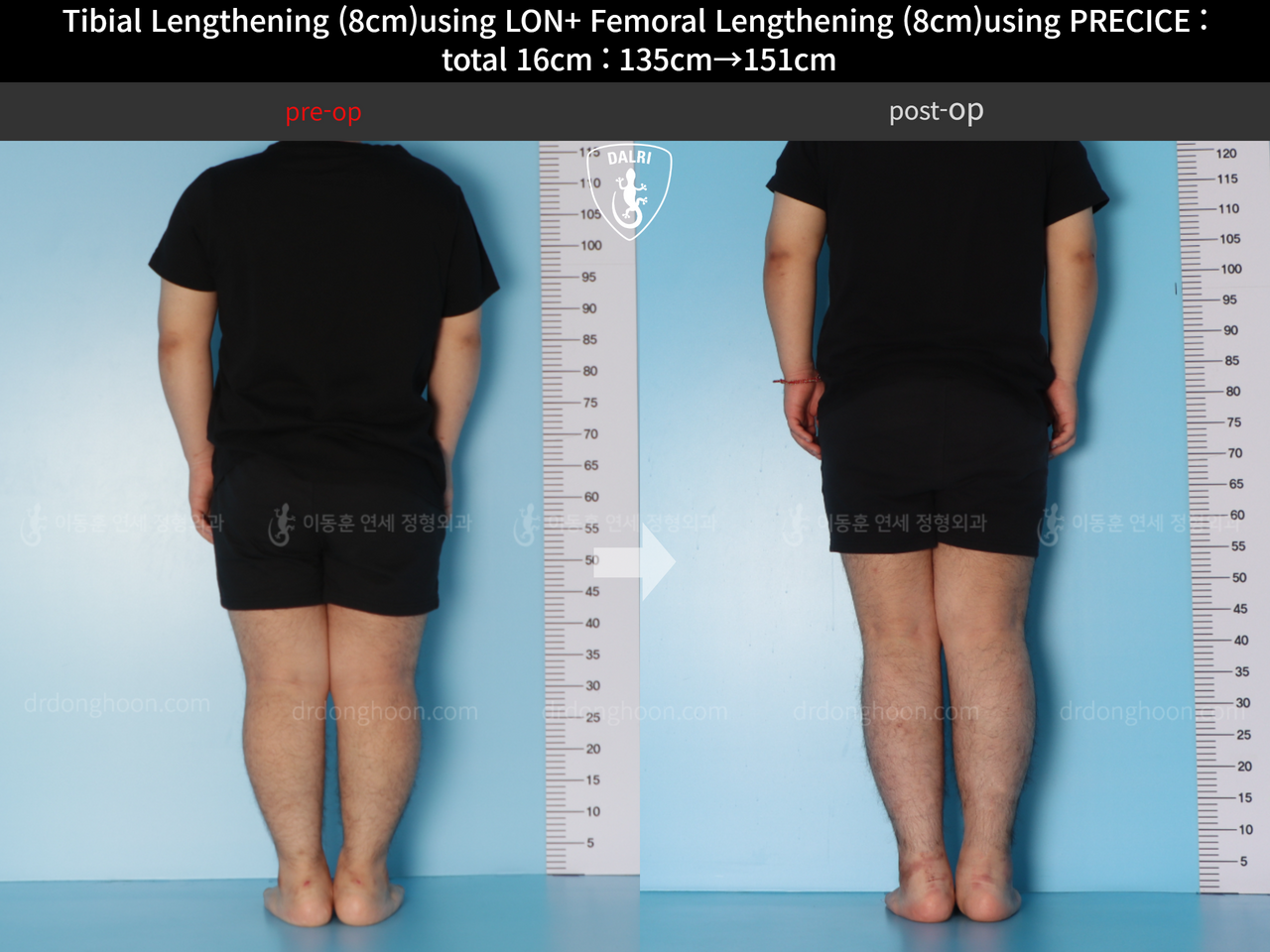 Before and after cll precice, case 12493963, image 5, Dr. Donghoon institute (DALRI)