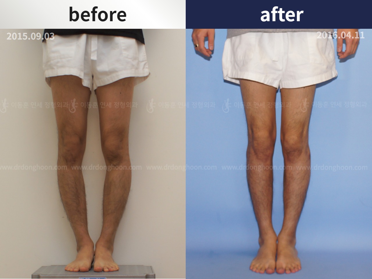 Before and after adult bowlegs, case 4311044, image 1, Dr. Donghoon institute (DALRI)