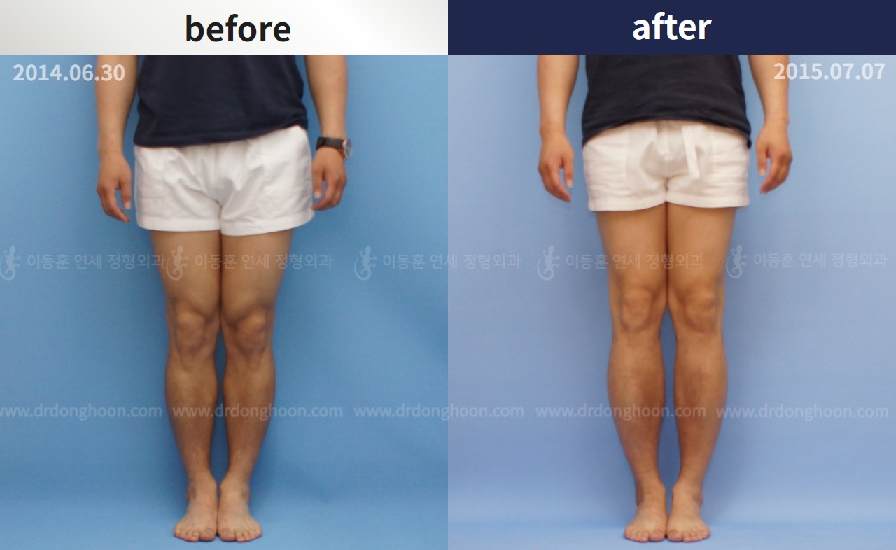 Before and after cll lon, case 4323961, image 1, Dr. Donghoon institute (DALRI)