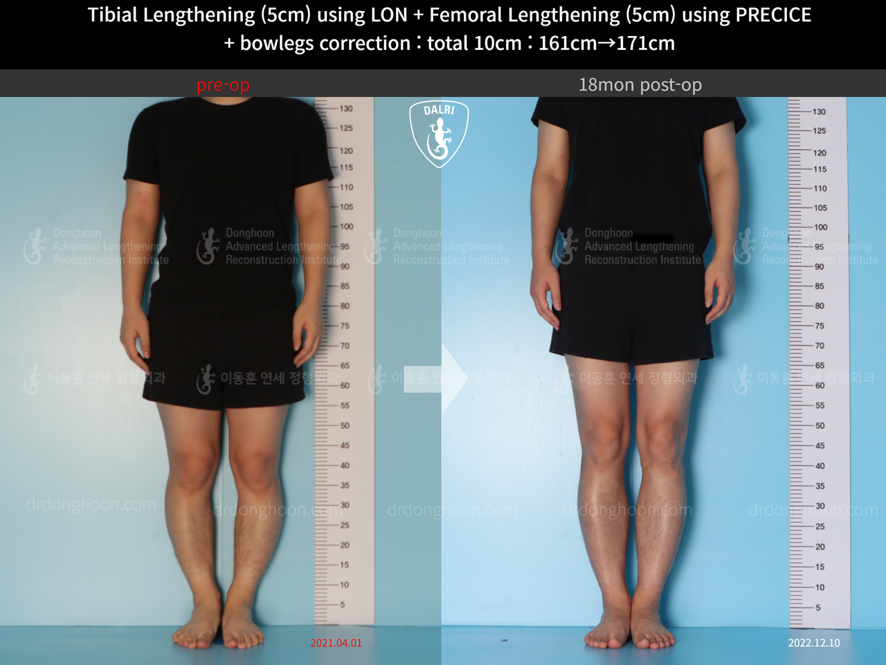 Before and after cll precice, case 13660867, image 3, Dr. Donghoon institute (DALRI)