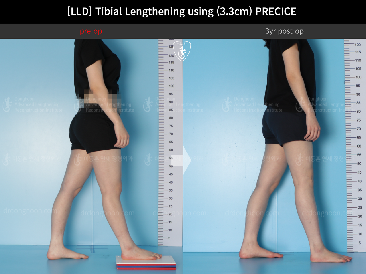 Before and after adult lld, case 14064905, image 6, Dr. Donghoon institute (DALRI)
