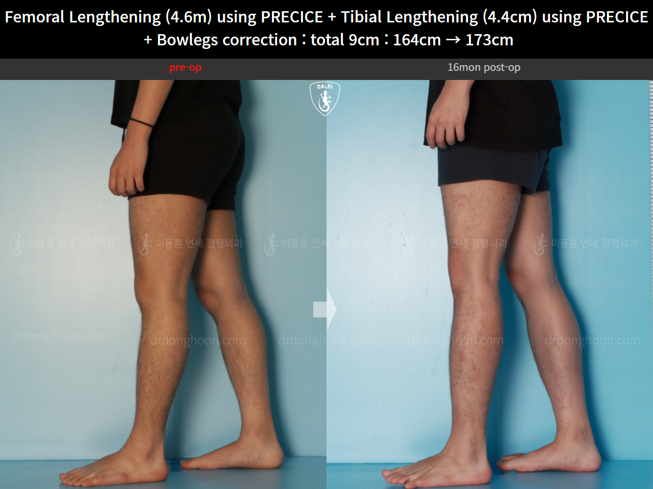 Before and after cll precice, case 16697524, image 12, Dr. Donghoon institute (DALRI)