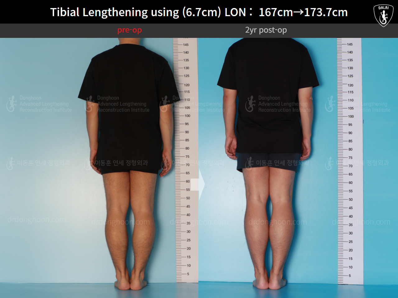 Before and after cll lon, case 16165376, image 2, Dr. Donghoon institute (DALRI)