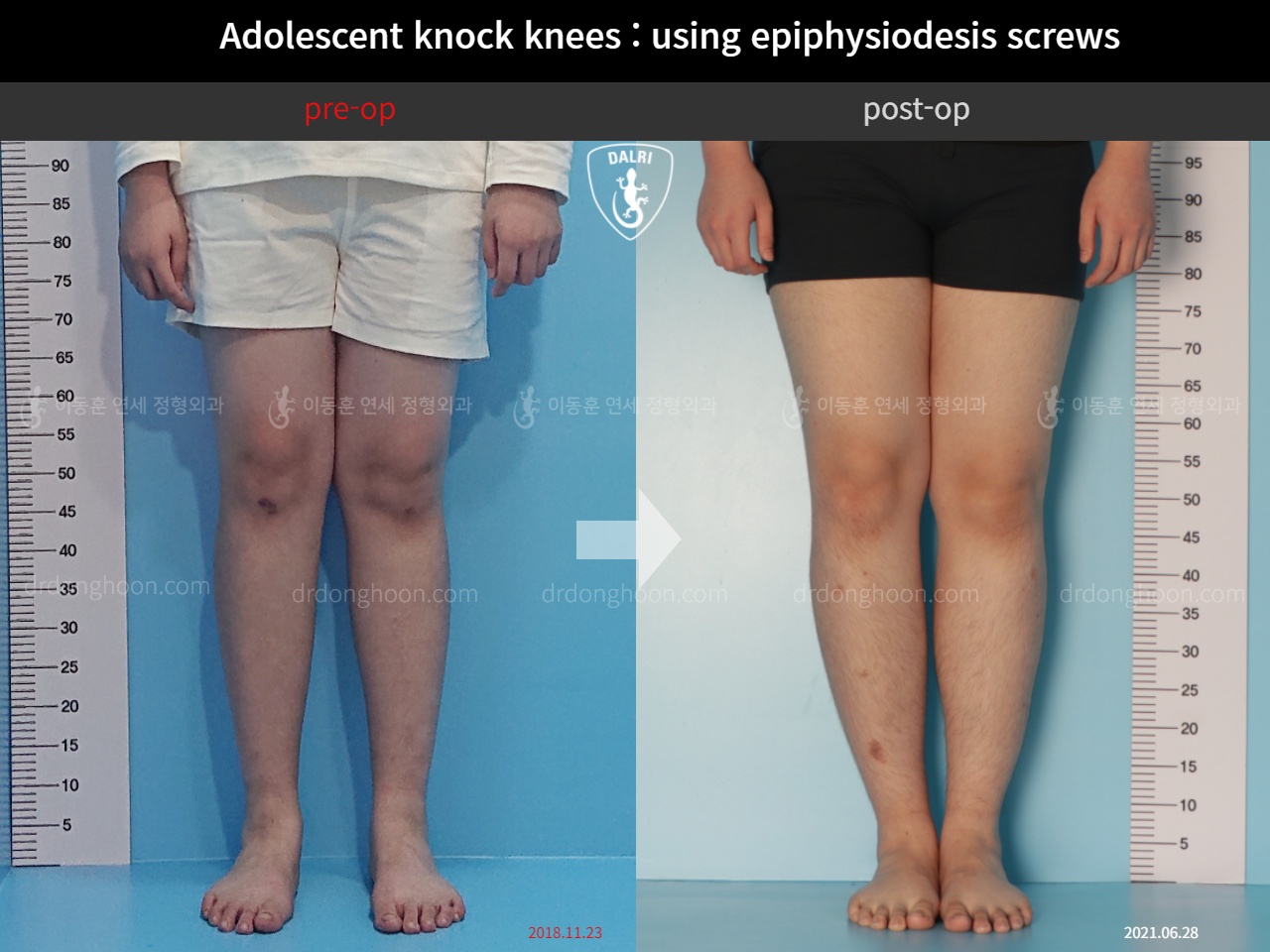 Before and after paediatric & adolescent knock knees, case 4310914, image 4, Dr. Donghoon institute (DALRI)