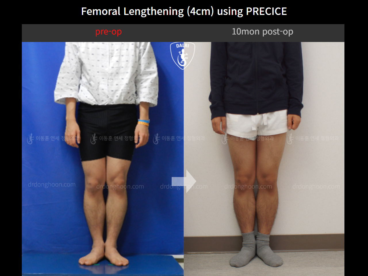 Before and after cll precice, case 4323369, image 4, Dr. Donghoon institute (DALRI)