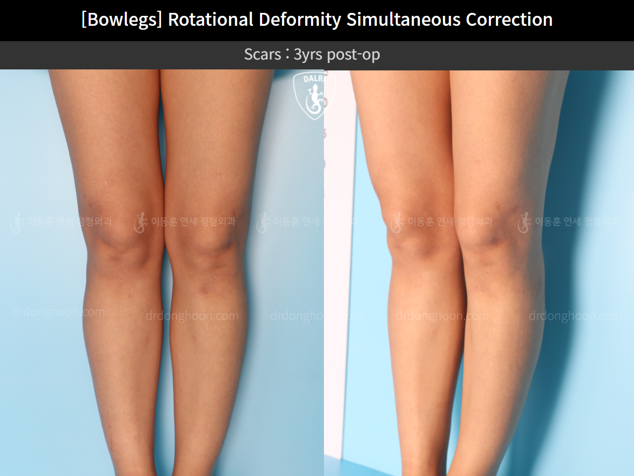 Before and after adult bowlegs, case 11789553, image 9, Dr. Donghoon institute (DALRI)