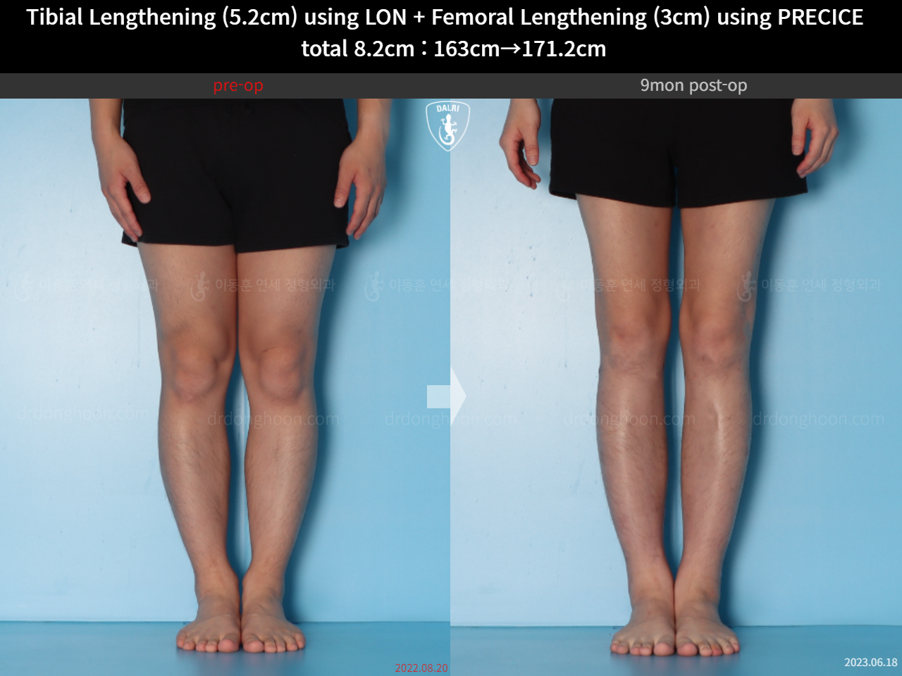 Before and after cll lon, case 15203339, image 10, Dr. Donghoon institute (DALRI)