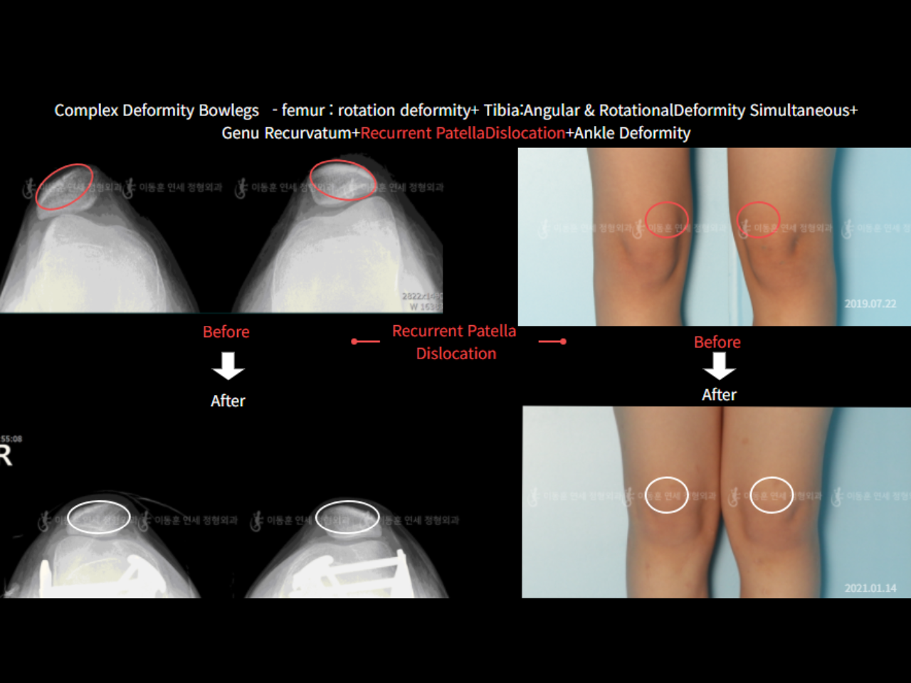 Before and after complex deformity, case 6883057, image 4, Dr. Donghoon institute (DALRI)