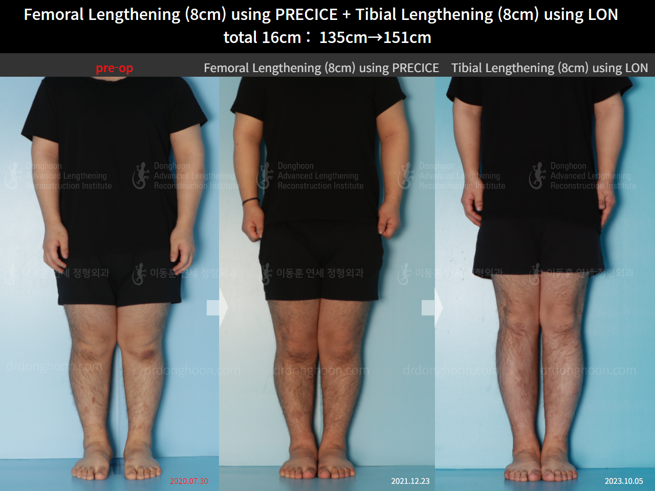 Before and after cll precice, case 16524724, image 1, Dr. Donghoon institute (DALRI)