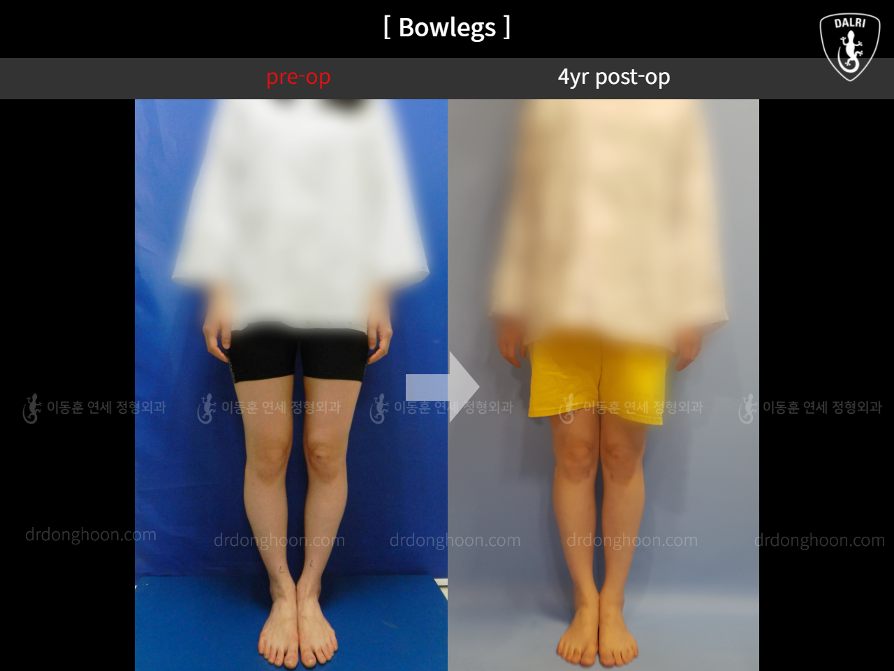 Before and after adult bowlegs, case 4310976, image 3, Dr. Donghoon institute (DALRI)