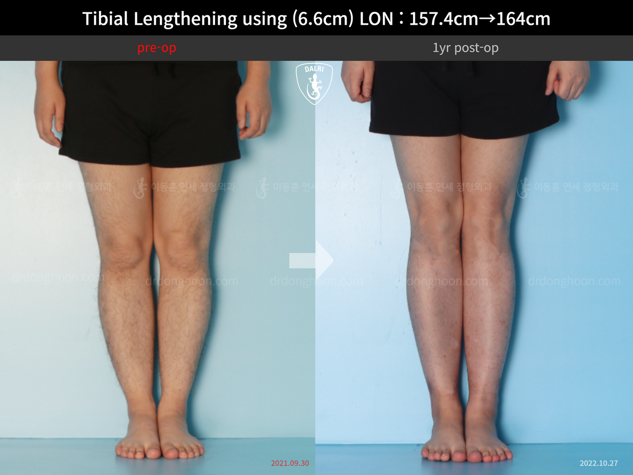 Before and after cll lon, case 13418098, image 5, Dr. Donghoon institute (DALRI)