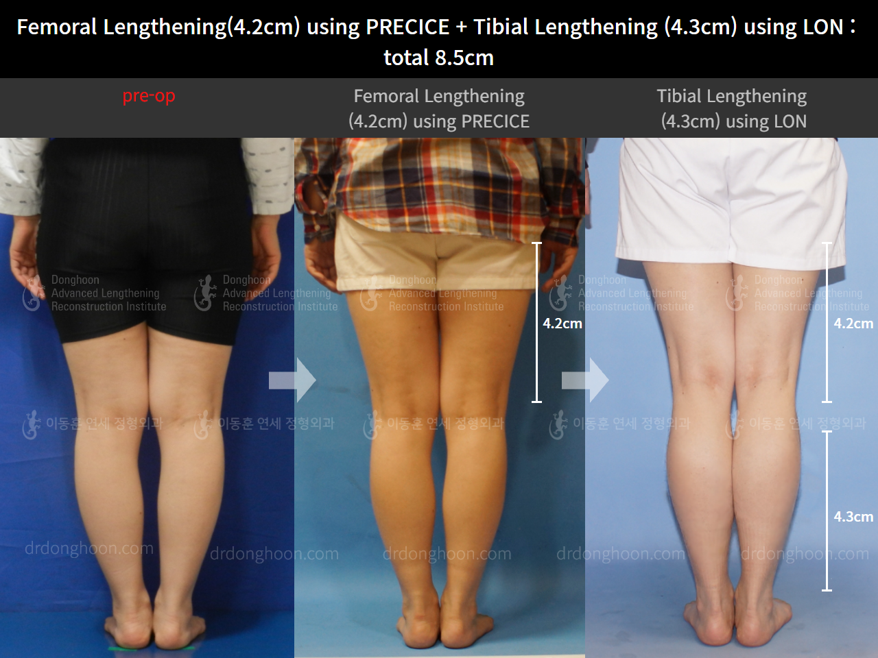 Before and after cll precice, case 9270537, image 2, Dr. Donghoon institute (DALRI)