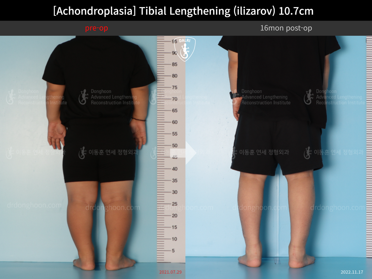 Before and after paediatric congenital condition, case 13489647, image 6, Dr. Donghoon institute (DALRI)