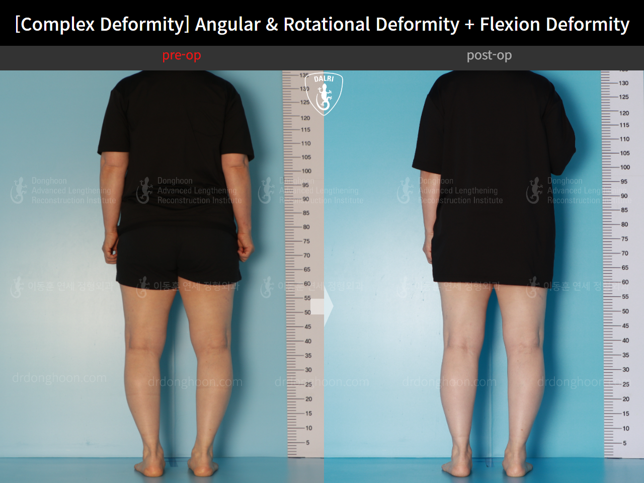 Before and after osteotomy for knee osteoarthritis, case 16781349, image 3, Dr. Donghoon institute (DALRI)