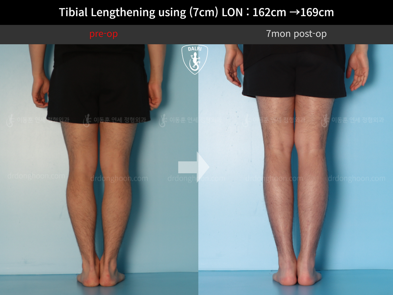 Before and after cll lon, case 13743472, image 10, Dr. Donghoon institute (DALRI)