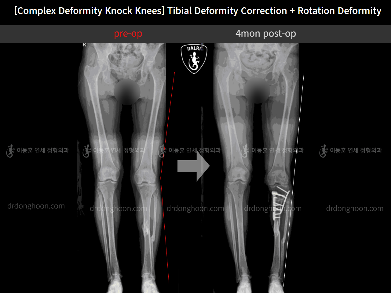 Before and after adult knock knees, case 11747832, image 6, Dr. Donghoon institute (DALRI)
