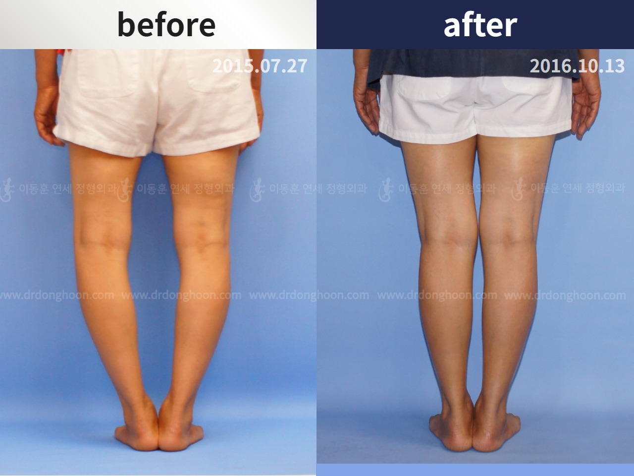 Before and after osteotomy for knee osteoarthritis, case 4306457, image 2, Dr. Donghoon institute (DALRI)