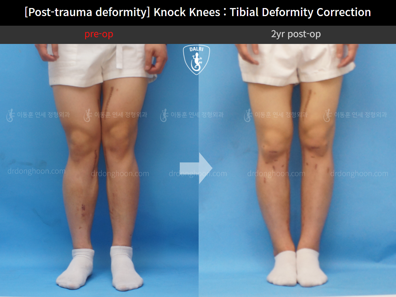 Before and after post-trauma deformity, case 9758216, image 3, Dr. Donghoon institute (DALRI)
