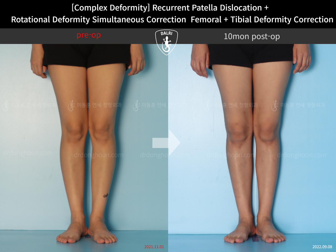 Before and after adult bowlegs, case 12860901, image 6, Dr. Donghoon institute (DALRI)