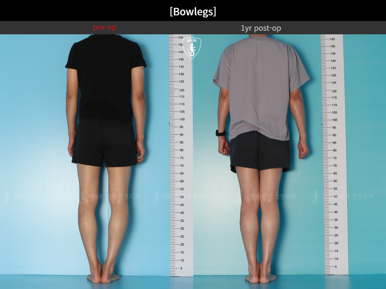 Before and after adult bowlegs, case 32564251, image 8, Dr. Donghoon institute (DALRI)