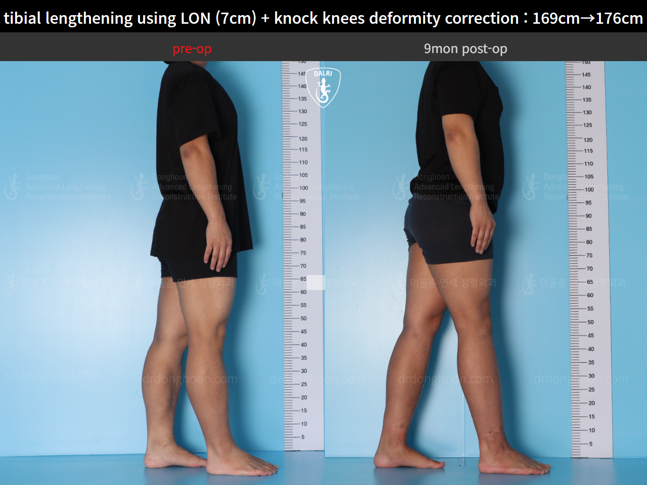 Before and after cll + deformity correction, case 15748291, image 3, Dr. Donghoon institute (DALRI)