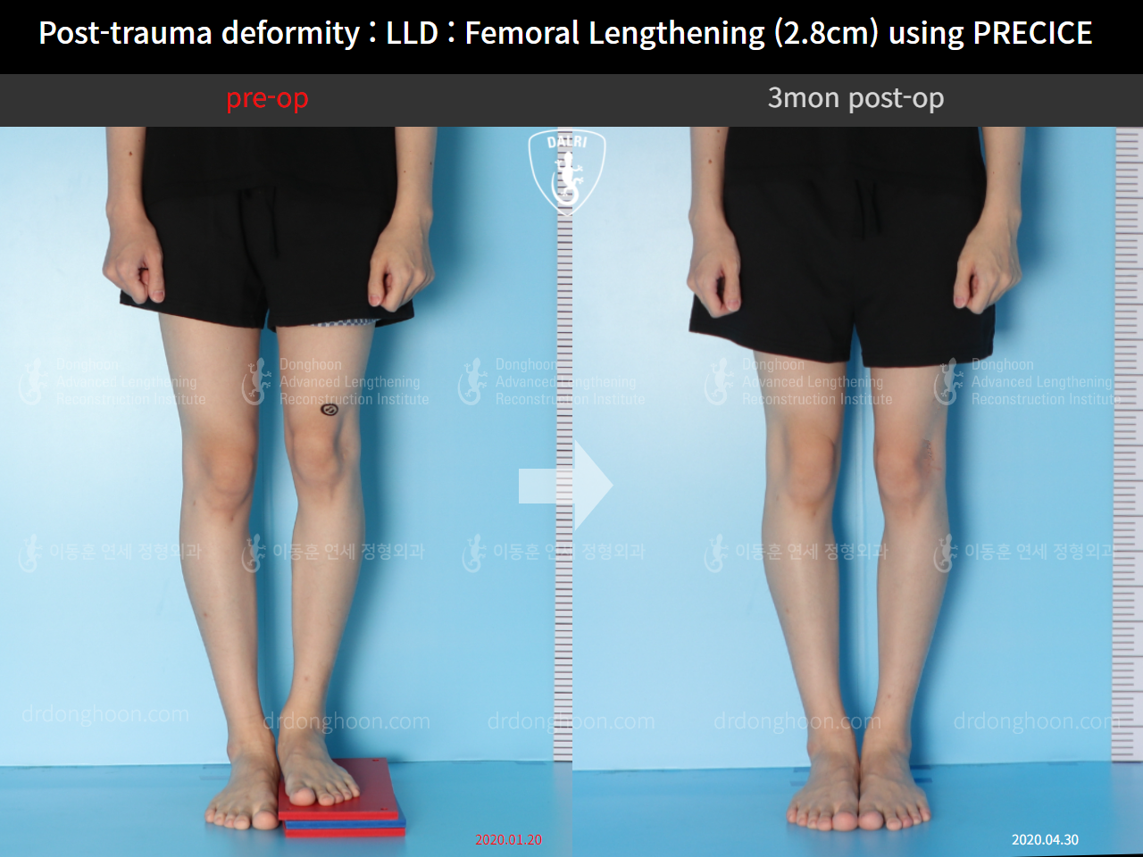 Before and after post-trauma deformity, case 10452246, image 3, Dr. Donghoon institute (DALRI)