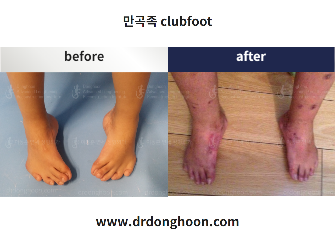 Before and after congenital clubfoot, case 4233847, image 3, Dr. Donghoon institute (DALRI)