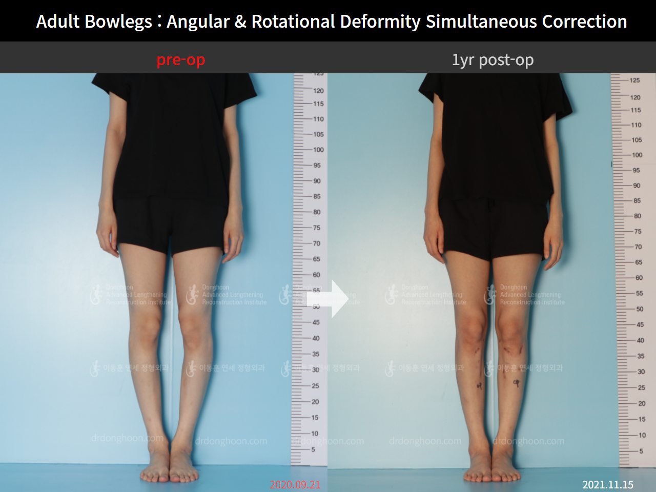 Before and after adult bowlegs, case 9058125, image 1, Dr. Donghoon institute (DALRI)