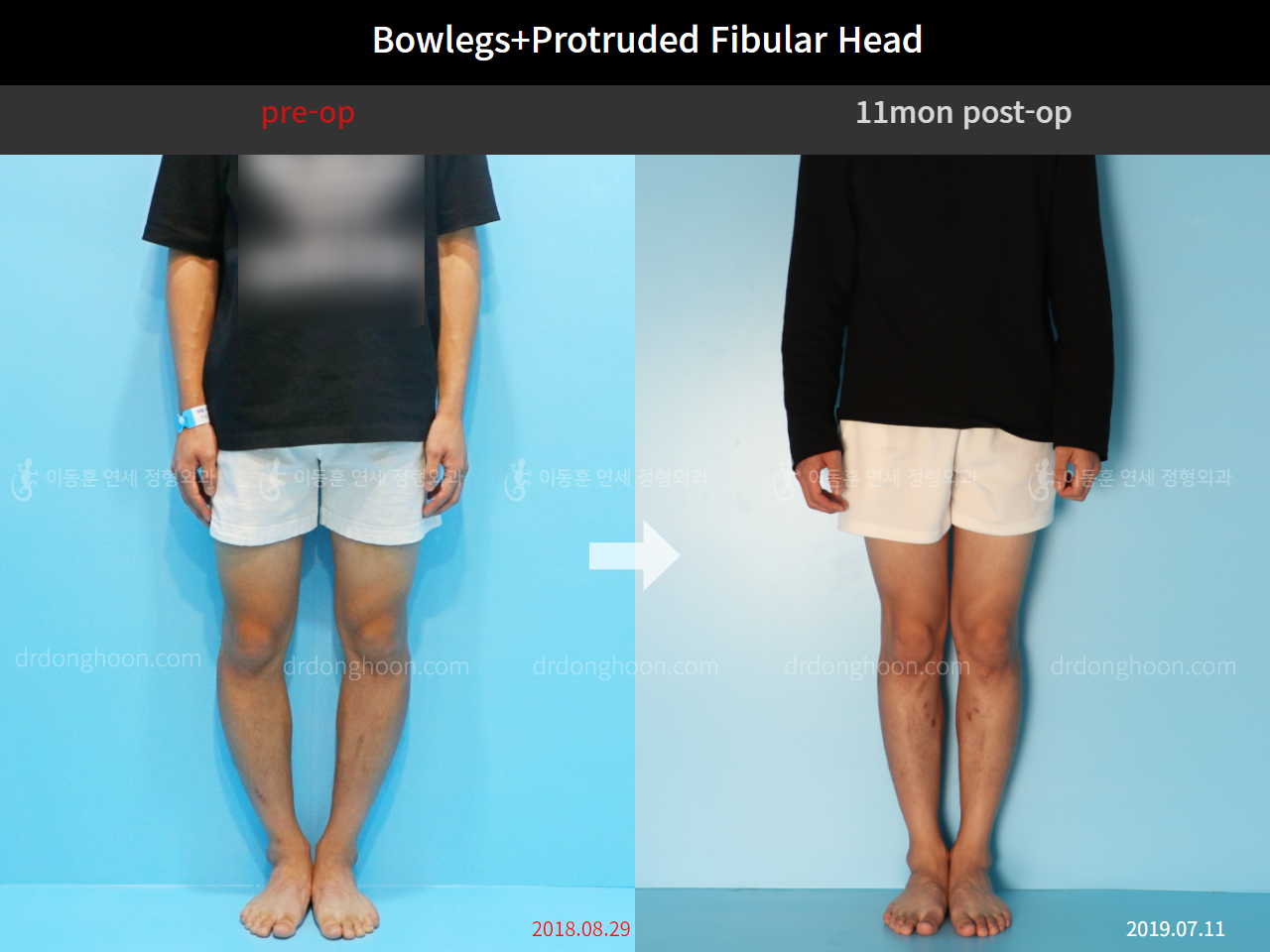 Before and after protruded fibular head, case 4248372, image 2, Dr. Donghoon institute (DALRI)