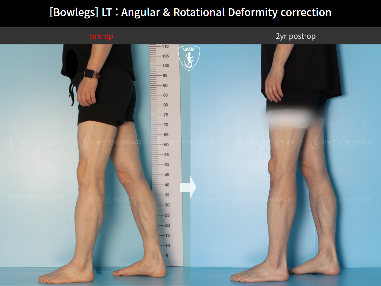 Before and after adult bowlegs, case 15111863, image 8, Dr. Donghoon institute (DALRI)