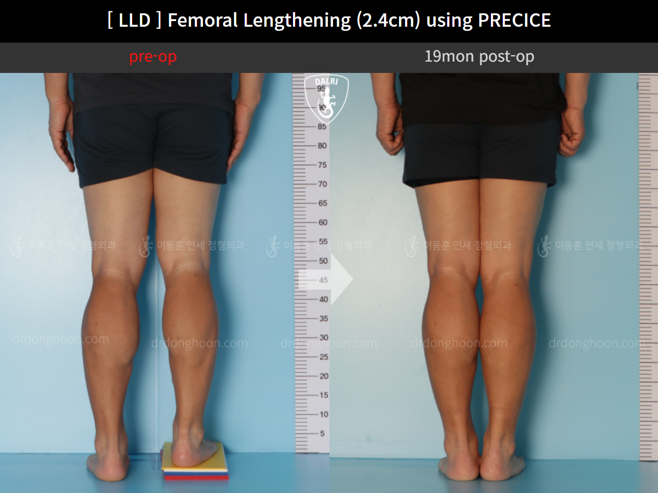 Before and after adult lld, case 10990486, image 6, Dr. Donghoon institute (DALRI)