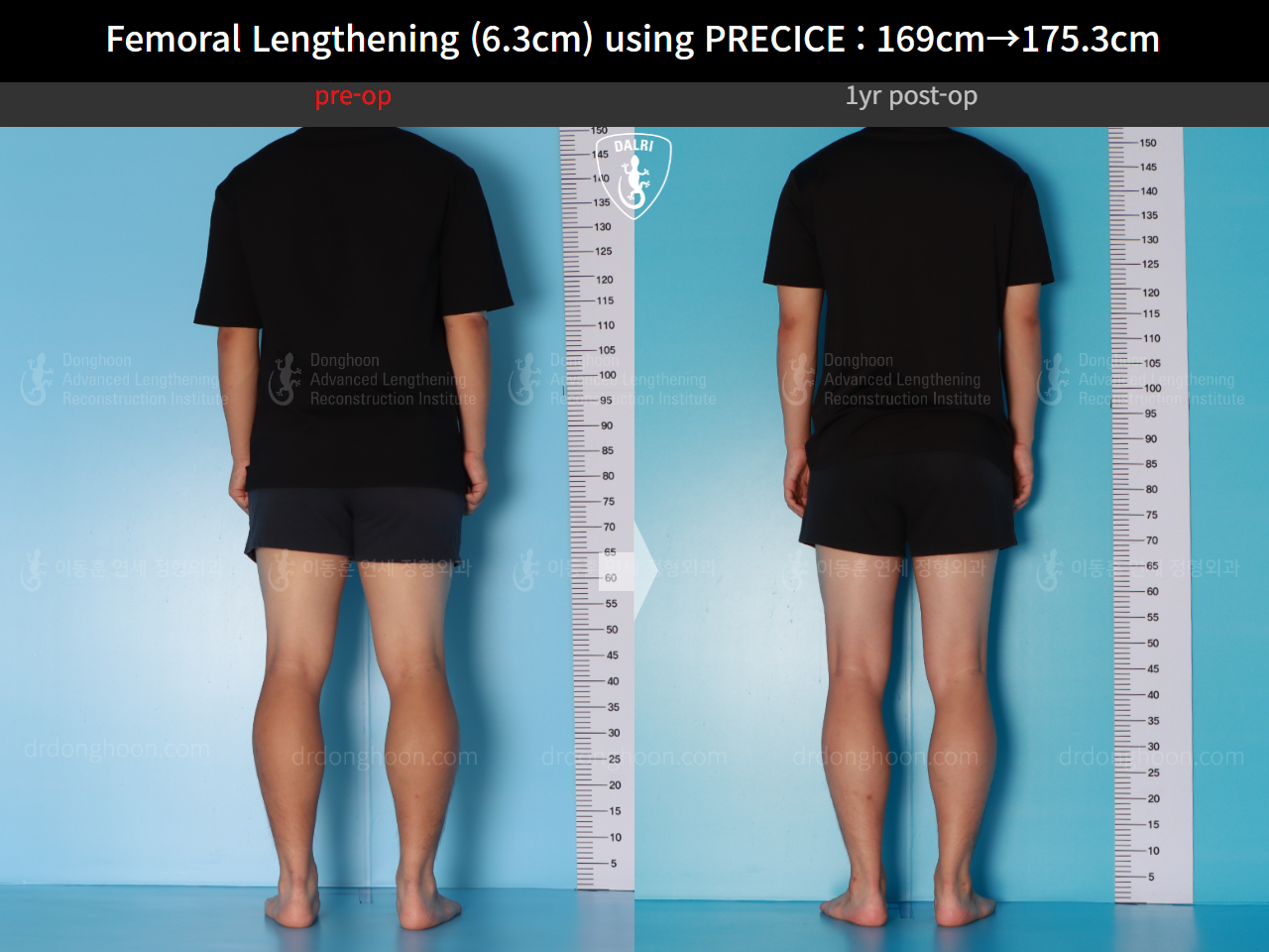Before and after cll precice, case 16070058, image 4, Dr. Donghoon institute (DALRI)