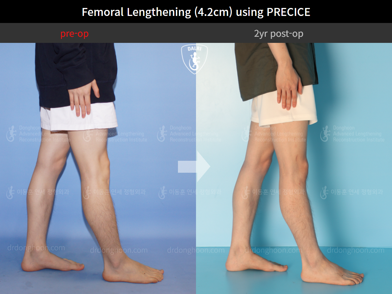 Before and after cll precice, case 4323396, image 7, Dr. Donghoon institute (DALRI)
