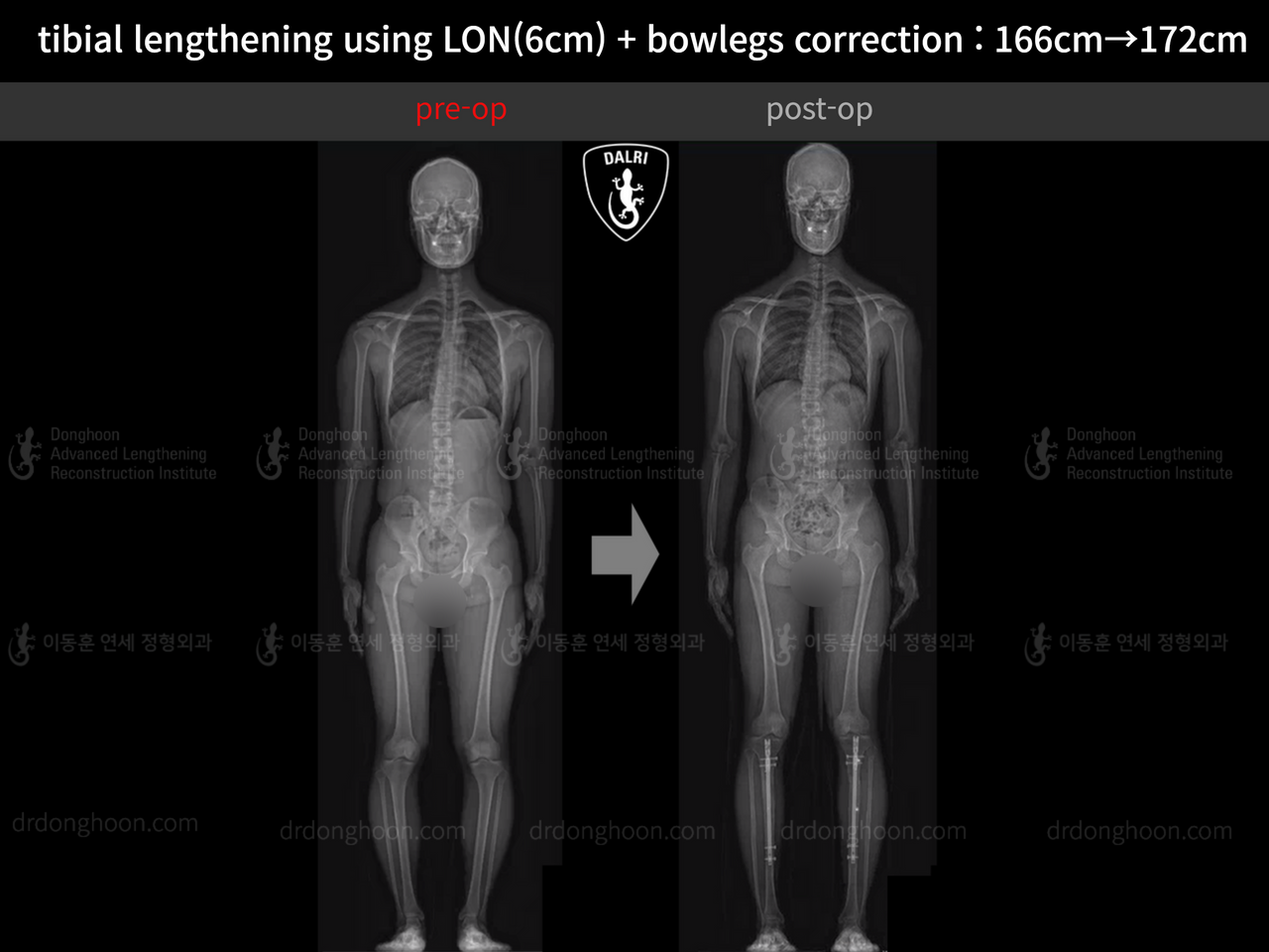 Before and after cll + deformity correction, case 13915297, image 1, Dr. Donghoon institute (DALRI)
